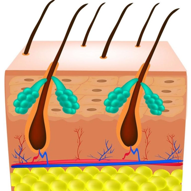 Seborrhea skin and hair. Dandruff seborrheic dermatitis. Eczema. Dysfunction of the sebaceous glands. Inflammatory skin disease. Anatomical structure. Infographics. Vector illustration