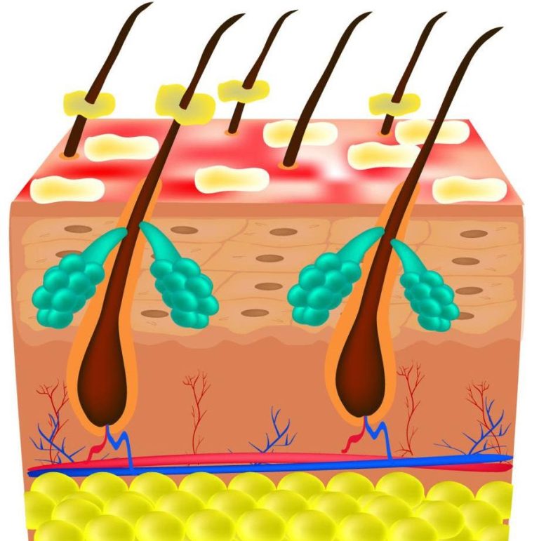 Seborrhea skin and hair. Dandruff seborrheic dermatitis. Eczema. Dysfunction of the sebaceous glands. Inflammatory skin disease. Anatomical structure. Infographics. Vector illustration